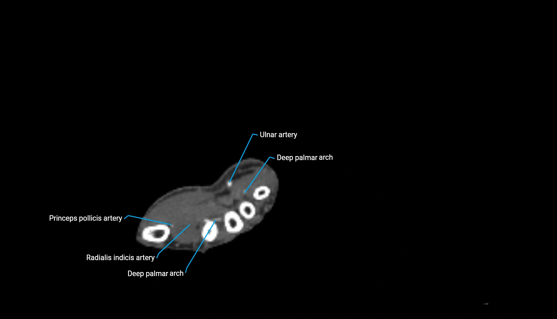 CTA upper limb axial cross sectional anatomy labelled image 64 (2).webp